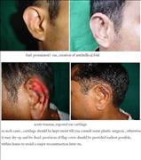 Before After Pictures,,Delhi,bat ear, prominent ear,otoplasty